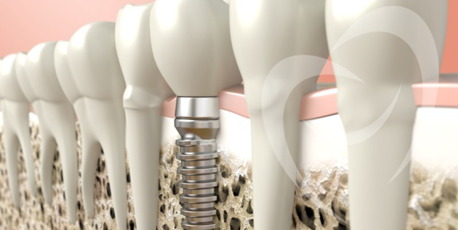 Leia mais sobre o artigo Como é feito o implante dentário?