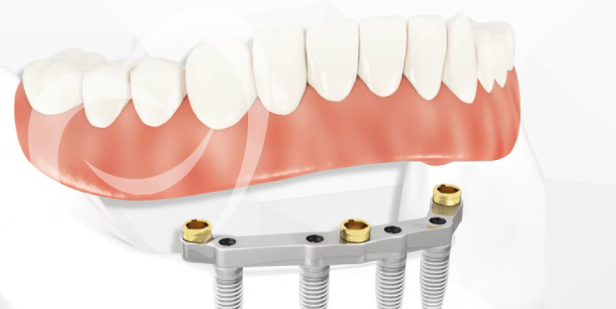 Leia mais sobre o artigo 6 Benefícios da Prótese Dentária sobre Implantes que você nãopode deixar de conhecer!