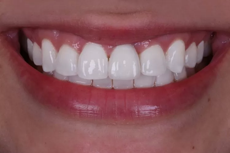 Implante dentário unitário