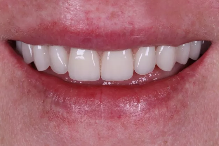 Prótese protocolo com cirurgia guiada