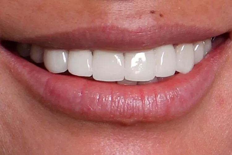Implante dentário no Instituto Kopp