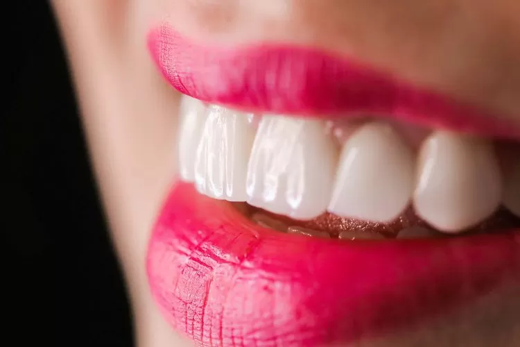 Lente de contato dental
