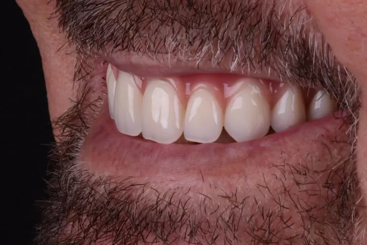 Prótese protocolo com cirurgia guiada