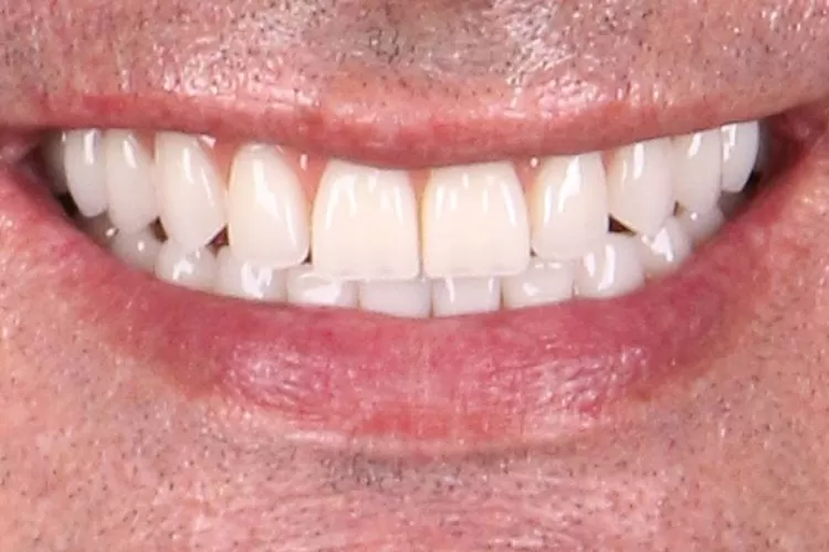 Prótese dentária protocolo com cirurgia guiada