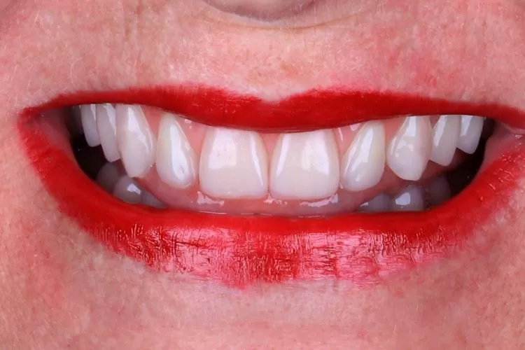 Cirurgia guiada com prótese dentária protocolo