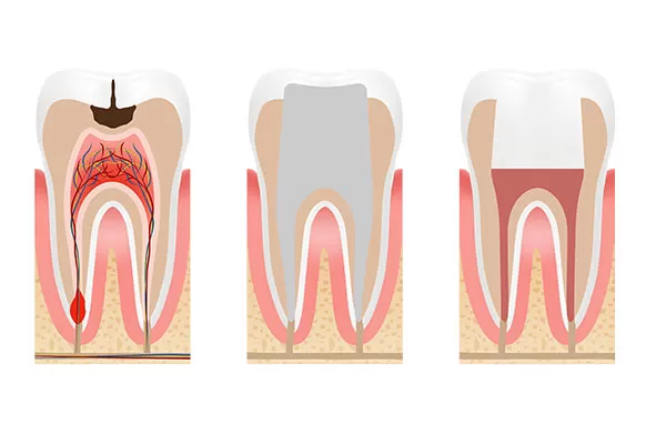 Tratamento de canal (endodontia) no Instituto Kopp