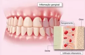 Profissional de periodontia examinando a gengiva