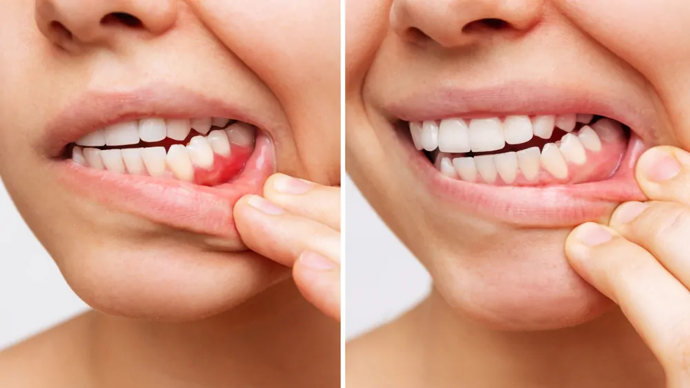 Tratamento de periodontia e saúde gengival no Instituto Kopp em Curitiba